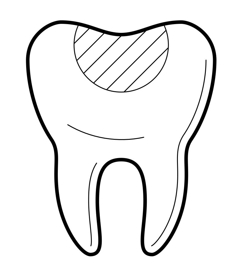 Tooth Coloured Fillings